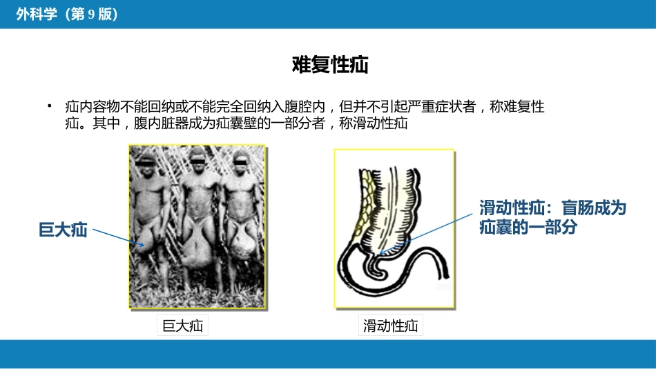 外科学： 腹外疝_第11页