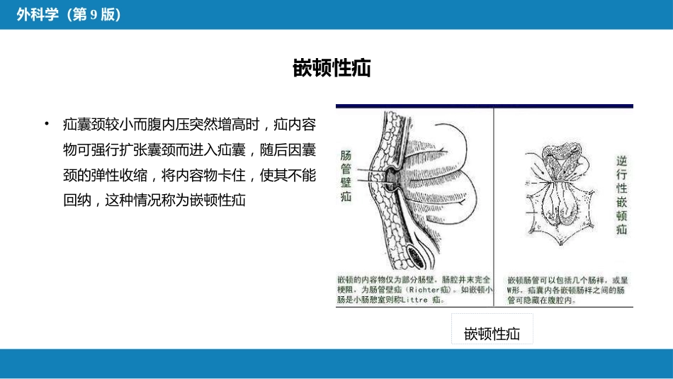 外科学： 腹外疝_第12页