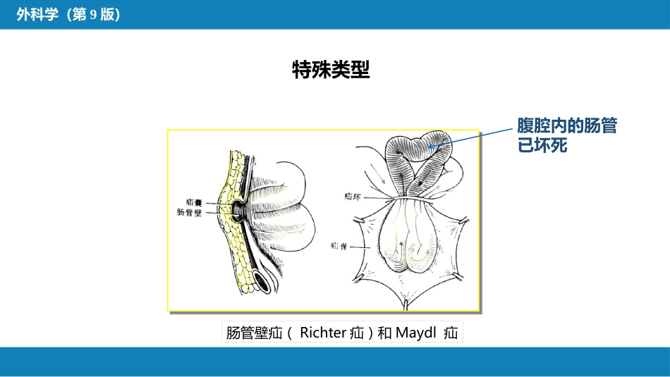 外科学： 腹外疝_第14页