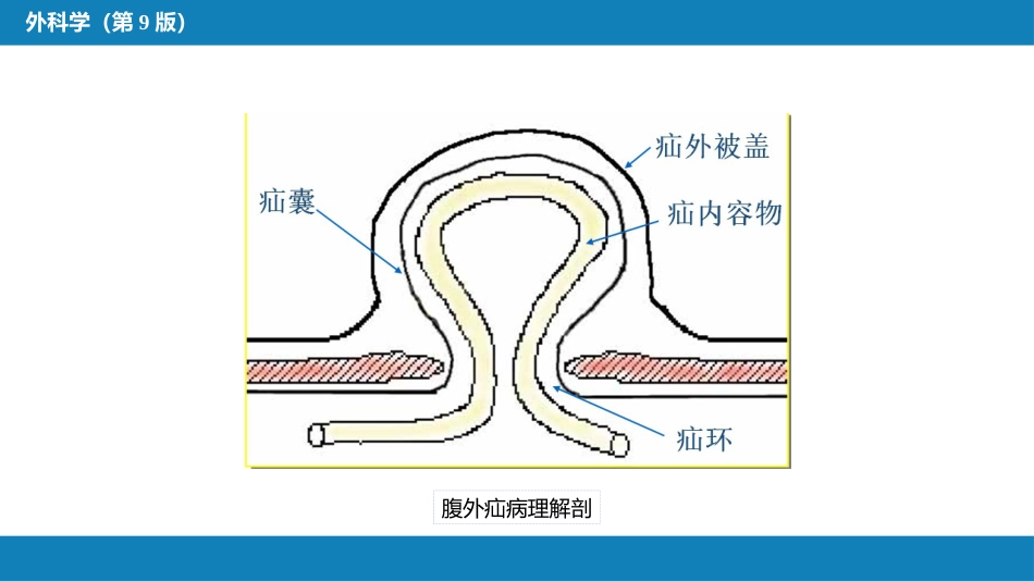 外科学： 腹外疝_第8页
