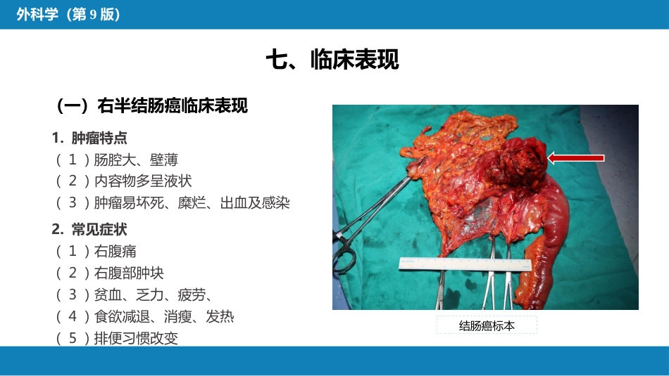 结、直肠与肛管疾病 第六节 结肠癌_第15页