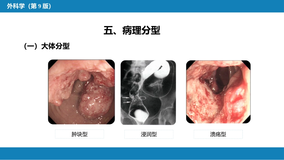 结、直肠与肛管疾病 第六节 结肠癌_第9页