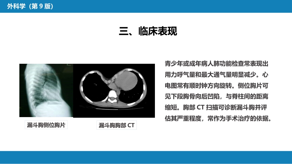 外科学： 胸壁、胸膜疾病_第8页