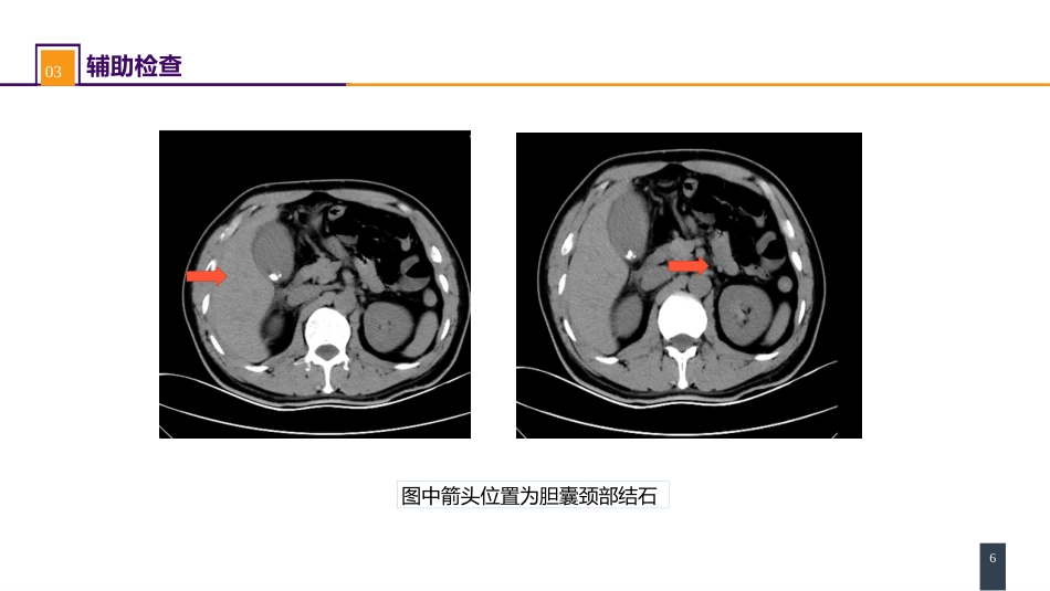 胆道疾病 案例分析-急性胆囊炎_第6页
