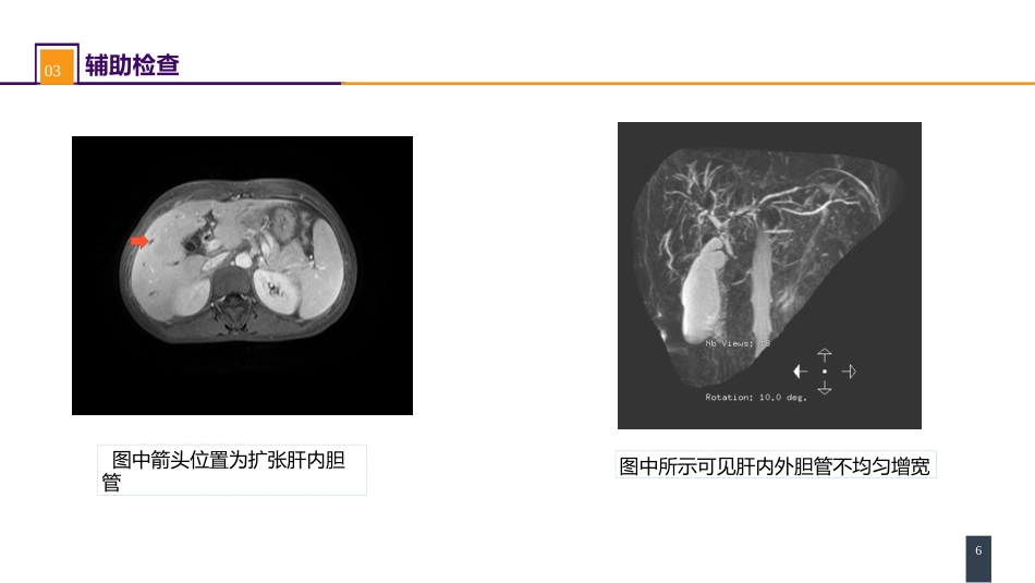 胆道疾病 案例分析-原发性硬化性胆管炎_第6页