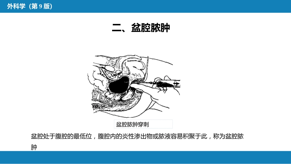 急性化脓性腹膜炎 第二节 腹腔脓肿_第10页