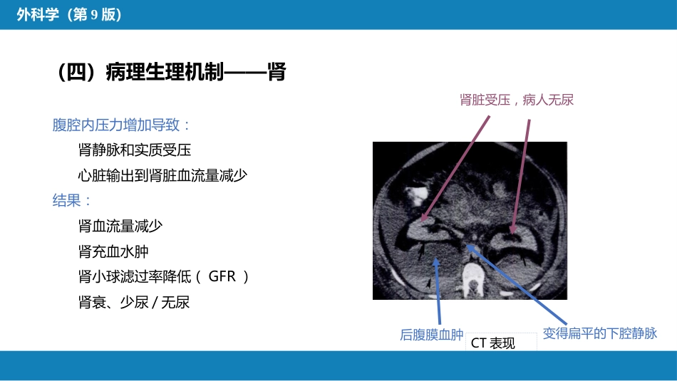 急性化脓性腹膜炎 第三节 腹腔间隔室综合征_第11页