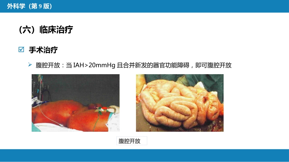 急性化脓性腹膜炎 第三节 腹腔间隔室综合征_第15页