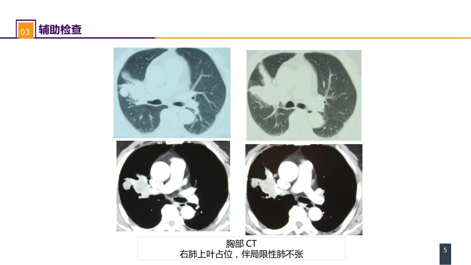 外科学：肺部疾病案例分析-原发性肺癌_第5页