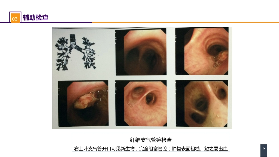外科学：肺部疾病案例分析-原发性肺癌_第6页