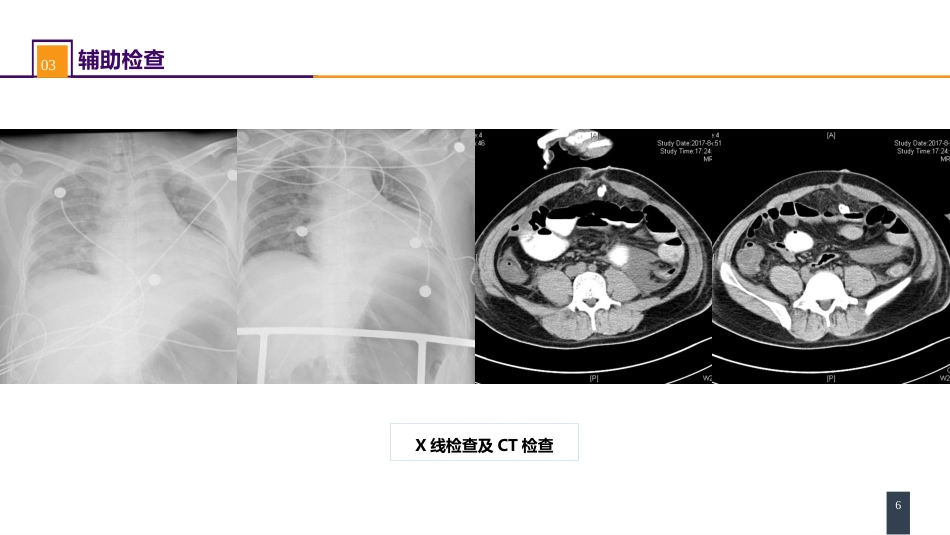 急性化脓性腹膜炎 案例分析-腹腔间隔室综合征_第6页