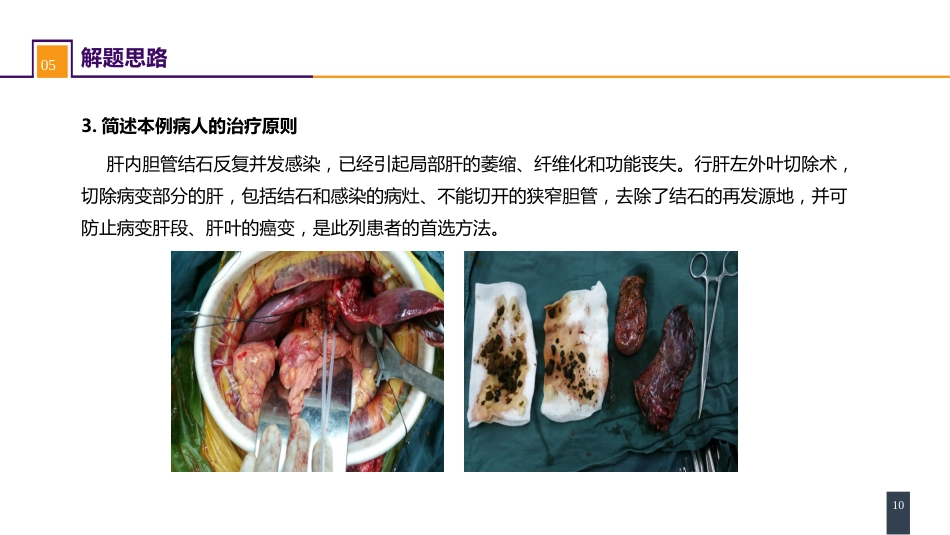 胆道疾病 案例分析-肝内胆管结石_第10页