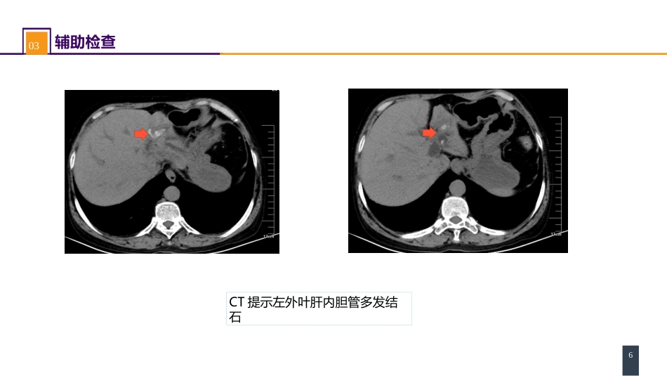 胆道疾病 案例分析-肝内胆管结石_第6页