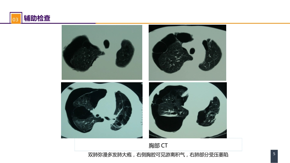 外科学：肺部疾病案例分析-肺大疱合并自发性气胸_第5页