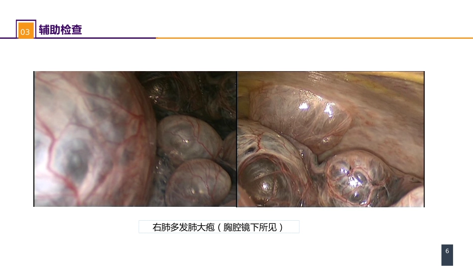 外科学：肺部疾病案例分析-肺大疱合并自发性气胸_第6页