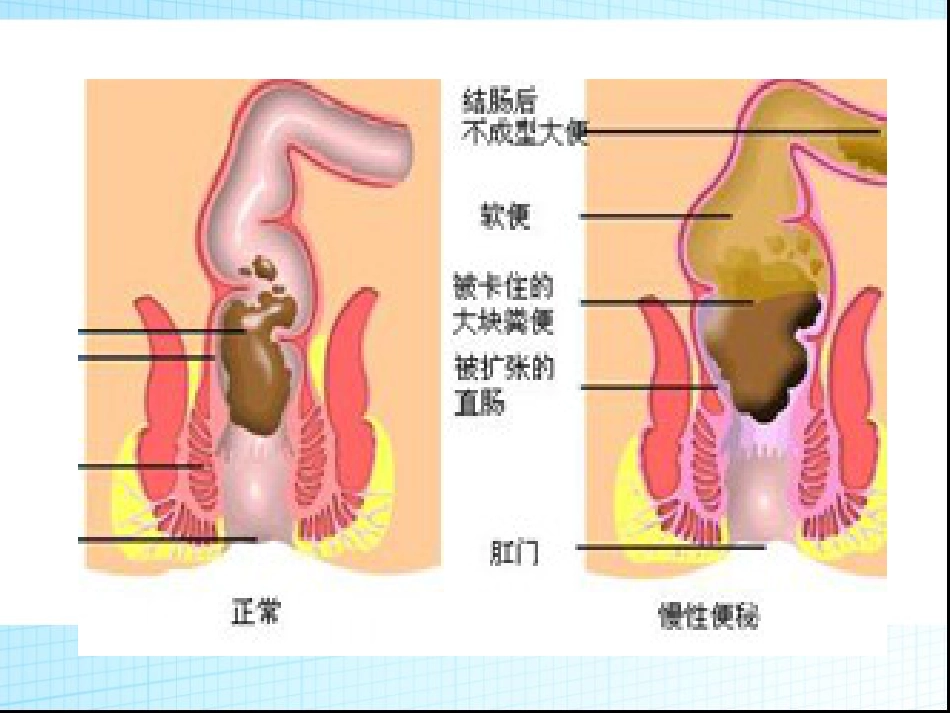 便秘的防治策略_第6页