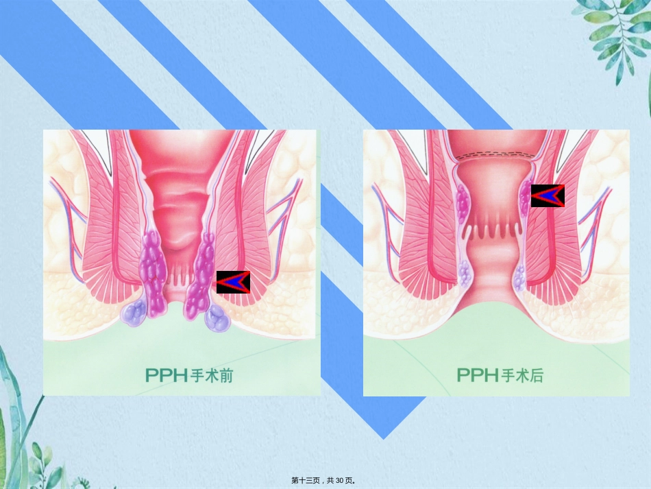 PPH—治疗痔疮的新技术_第13页