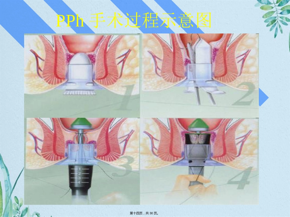 PPH—治疗痔疮的新技术_第14页