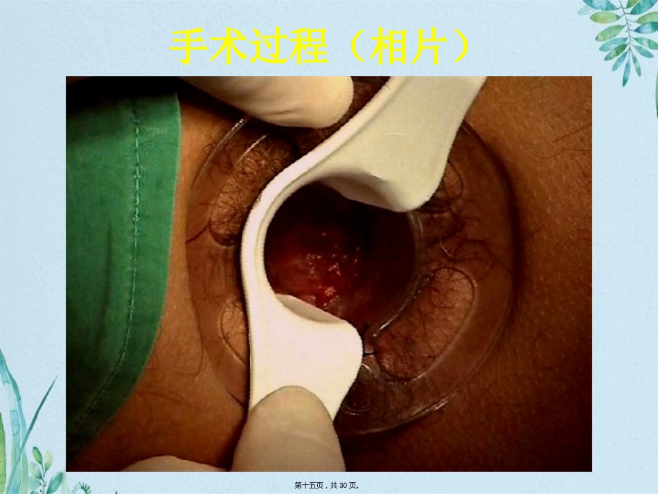 PPH—治疗痔疮的新技术_第15页
