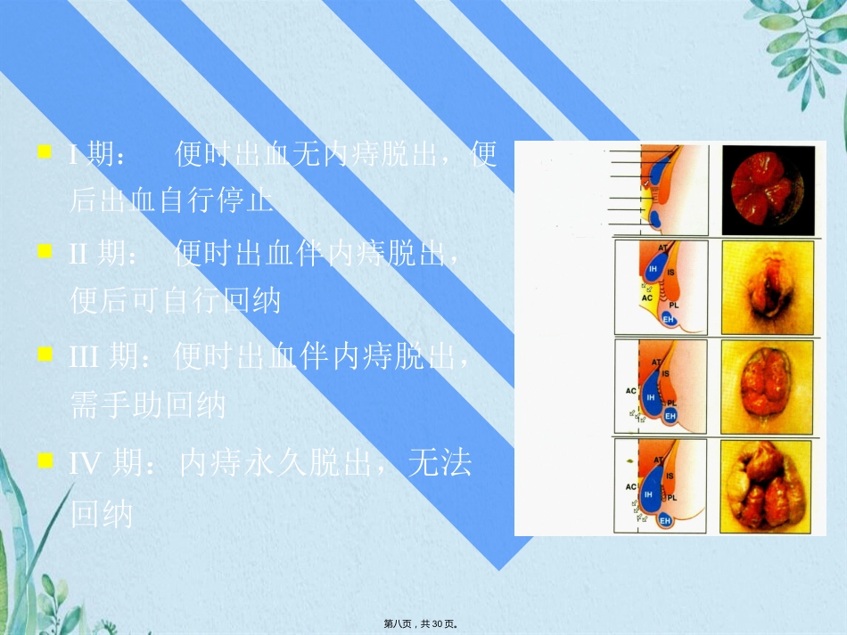 PPH—治疗痔疮的新技术_第8页