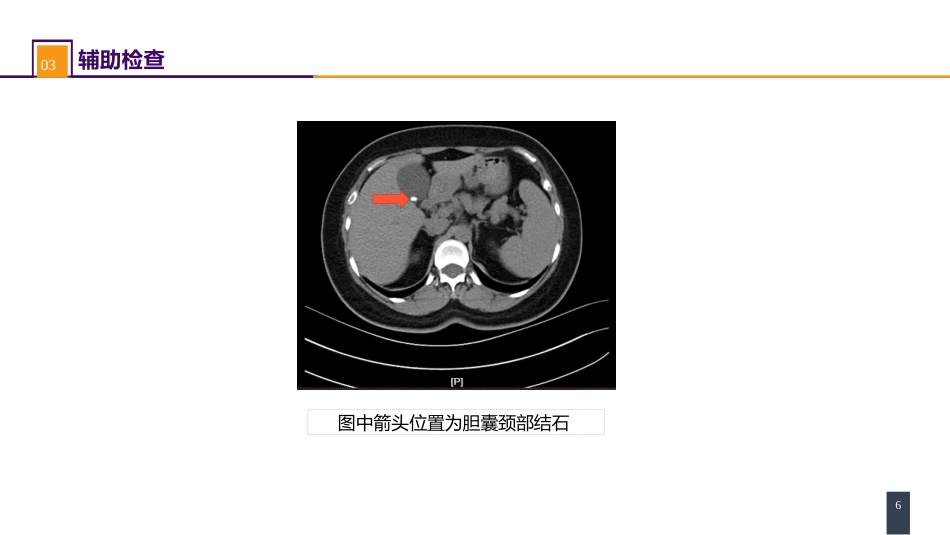 胆道疾病 案例分析-慢性胆囊炎_第6页
