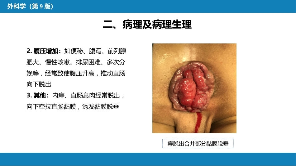 结、直肠与肛管疾病 第十三节 直肠脱垂_第10页
