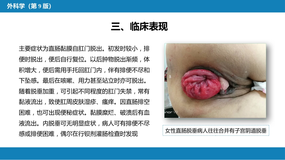 结、直肠与肛管疾病 第十三节 直肠脱垂_第12页