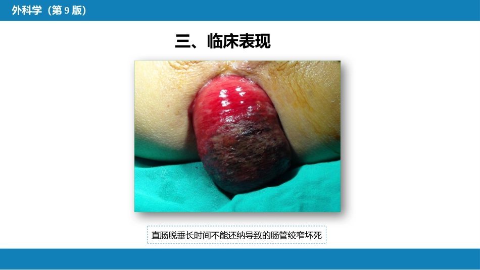 结、直肠与肛管疾病 第十三节 直肠脱垂_第13页