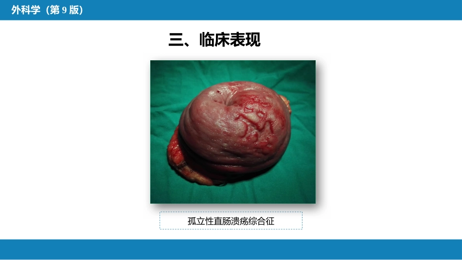 结、直肠与肛管疾病 第十三节 直肠脱垂_第14页