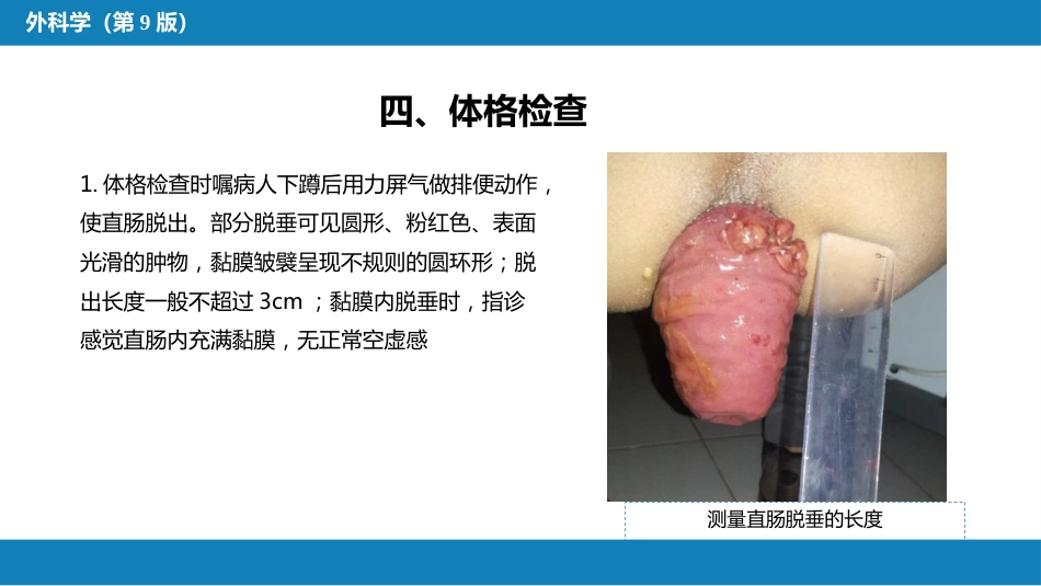 结、直肠与肛管疾病 第十三节 直肠脱垂_第15页