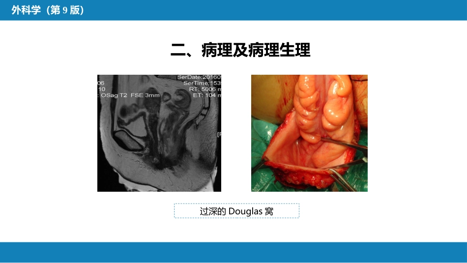 结、直肠与肛管疾病 第十三节 直肠脱垂_第6页