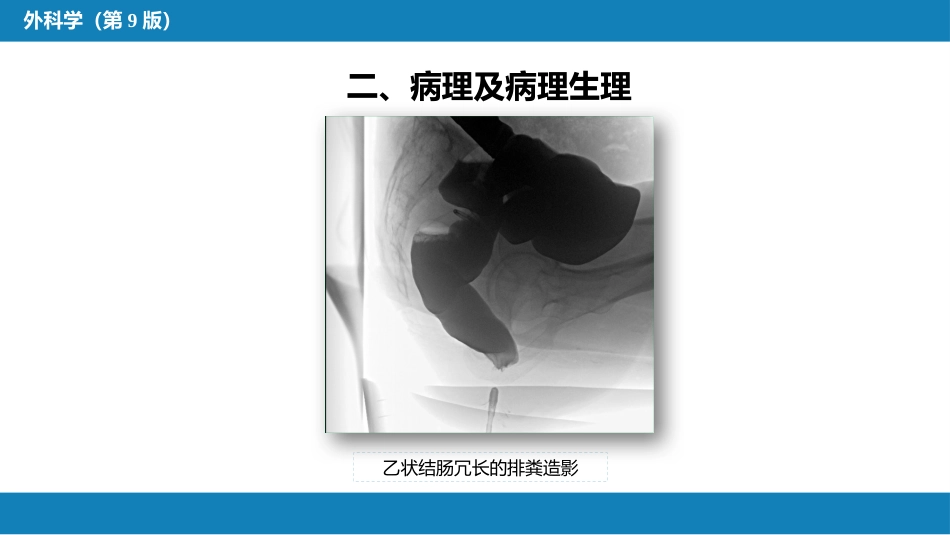 结、直肠与肛管疾病 第十三节 直肠脱垂_第7页