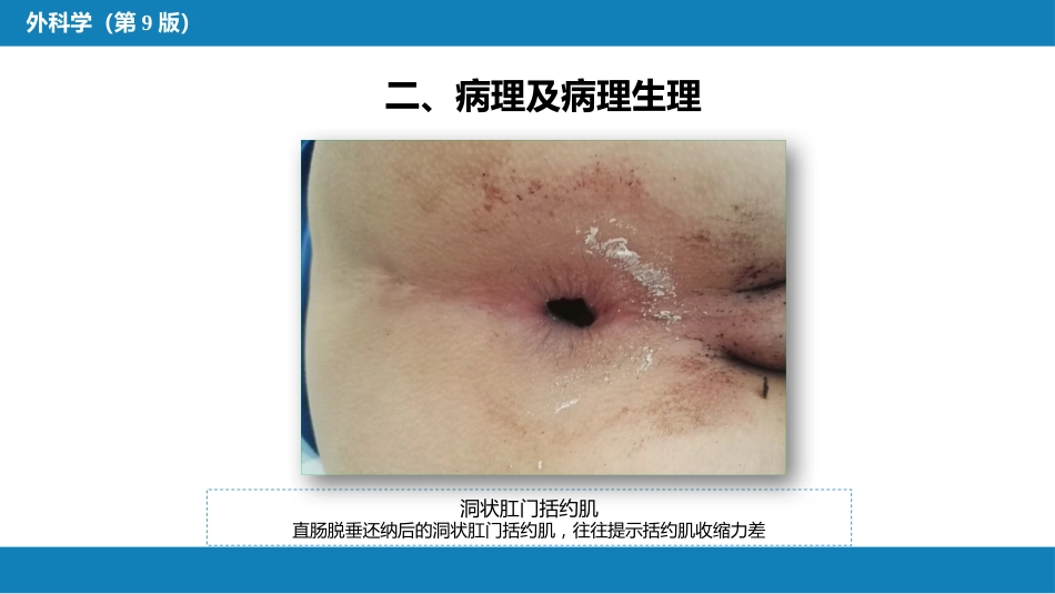 结、直肠与肛管疾病 第十三节 直肠脱垂_第8页