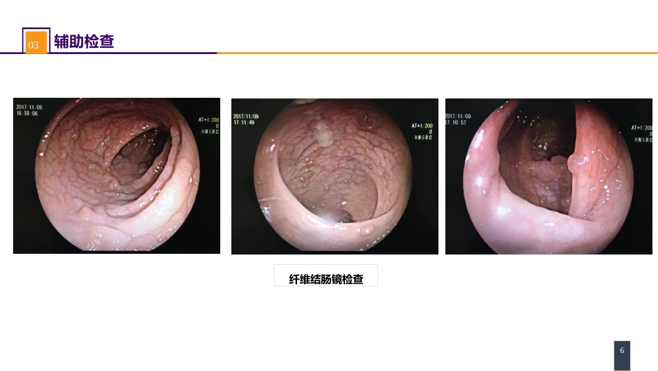 结、直肠与肛管疾病 案例分析-家族性腺瘤性息肉病_第6页