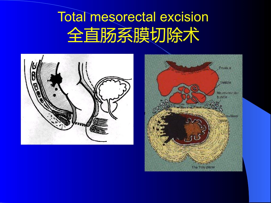 TME,直肠癌全系膜切除术_第8页