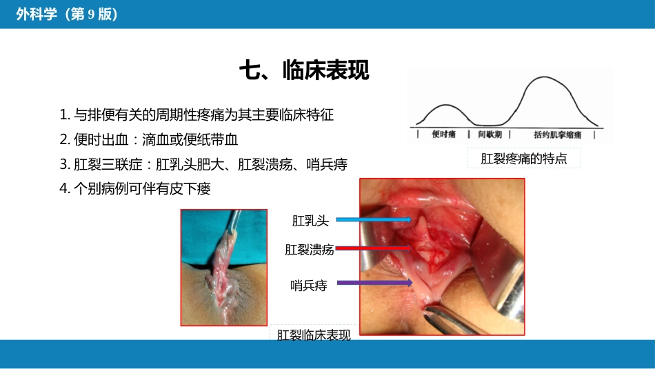 结、直肠与肛管疾病 第九、十、十一节_第6页