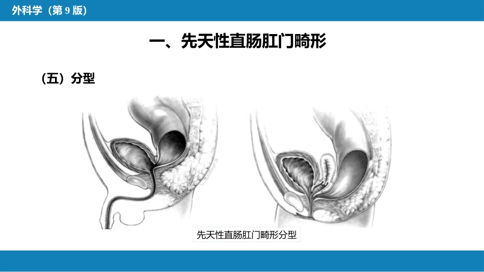 结、直肠与肛管疾病 第八节 结直肠和肛管疾病_第11页