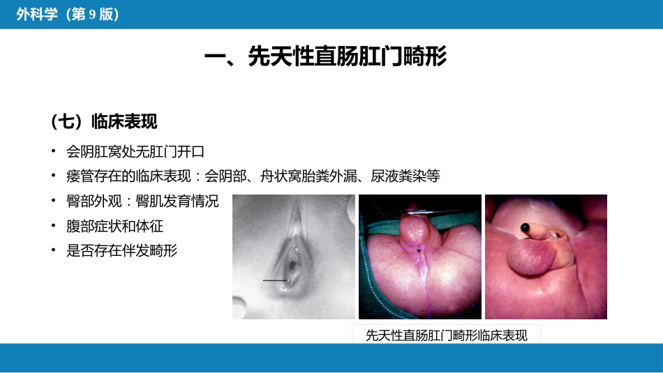 结、直肠与肛管疾病 第八节 结直肠和肛管疾病_第14页