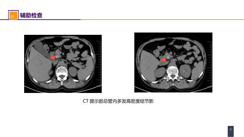 胆道疾病 案例分析-肝外胆管结石_第6页