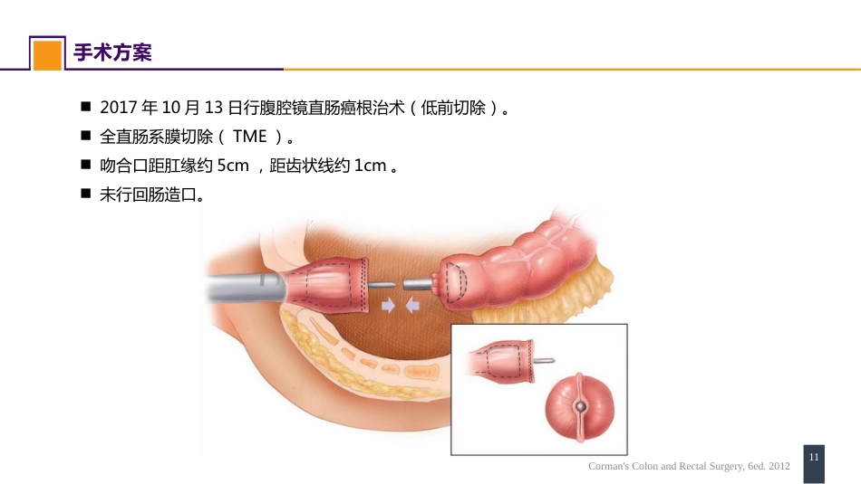 结、直肠与肛管疾病 案例分析-直肠癌_第11页