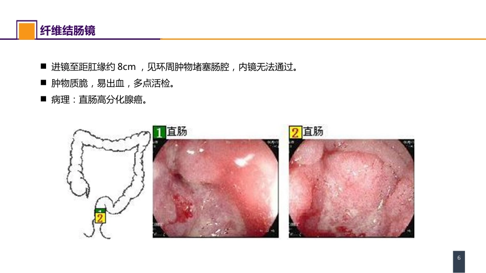 结、直肠与肛管疾病 案例分析-直肠癌_第6页