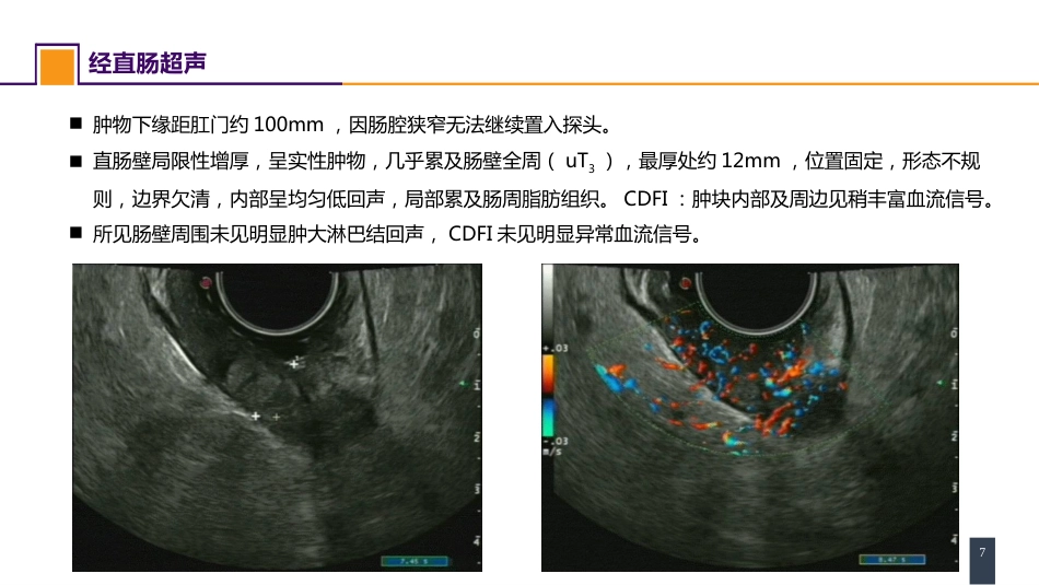 结、直肠与肛管疾病 案例分析-直肠癌_第7页