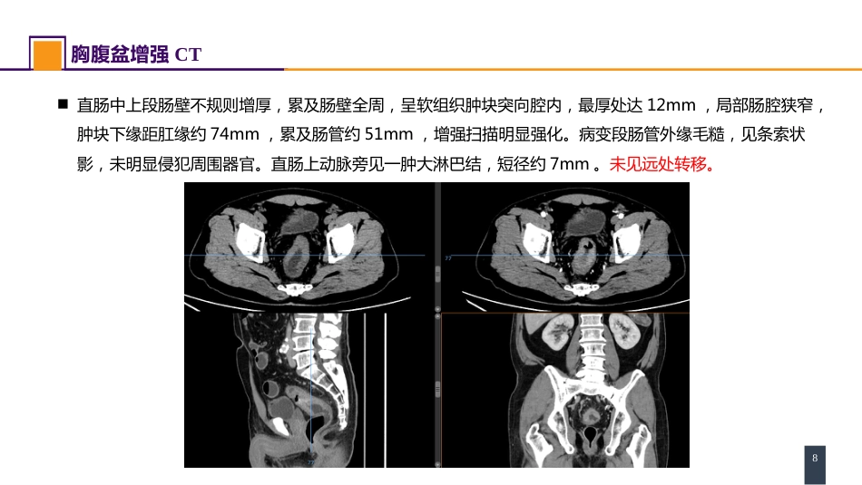 结、直肠与肛管疾病 案例分析-直肠癌_第8页