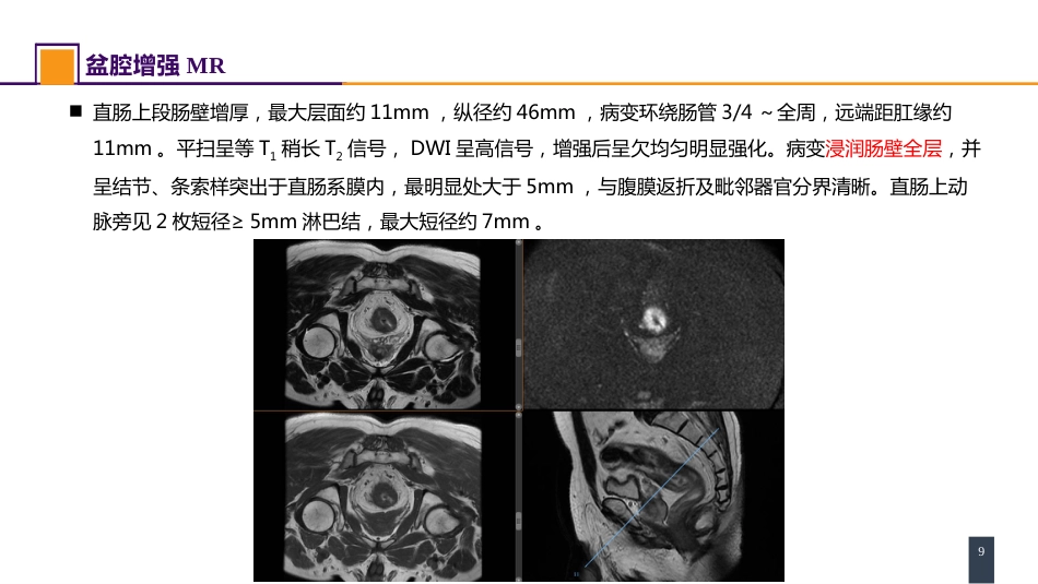 结、直肠与肛管疾病 案例分析-直肠癌_第9页