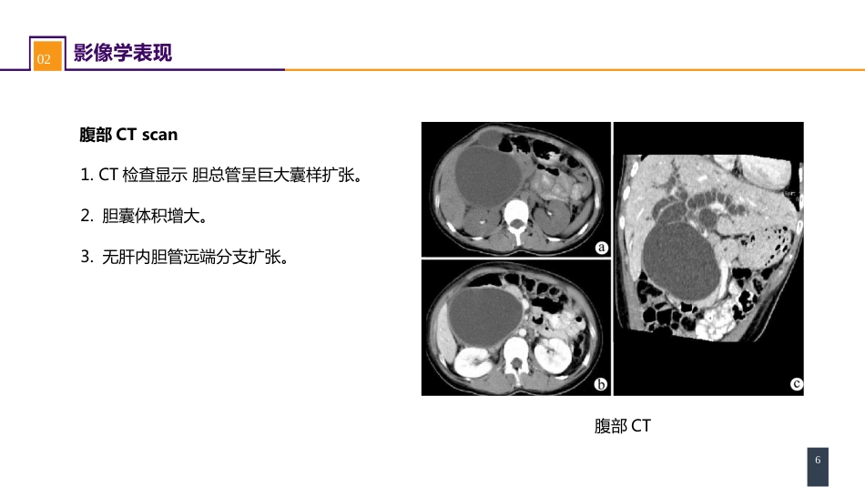胆道疾病 案例分析-胆管扩张_第6页
