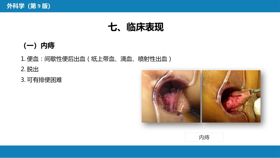 结、直肠与肛管疾病 第十二节 痔_第10页