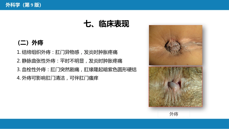 结、直肠与肛管疾病 第十二节 痔_第11页