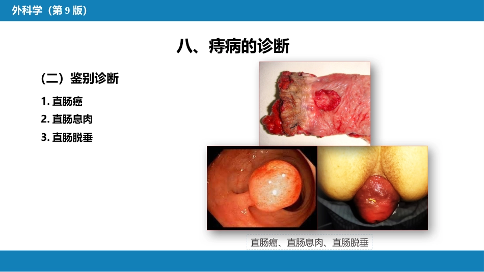 结、直肠与肛管疾病 第十二节 痔_第15页