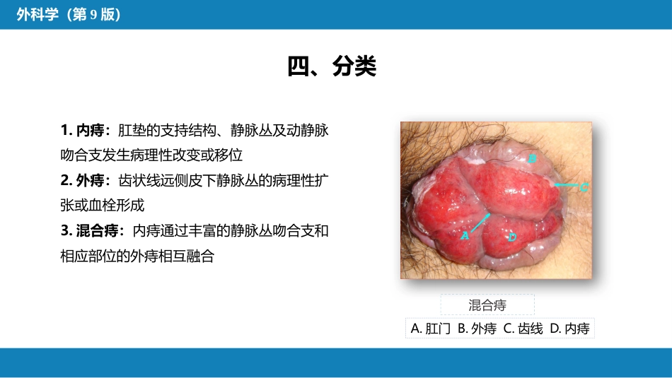 结、直肠与肛管疾病 第十二节 痔_第7页