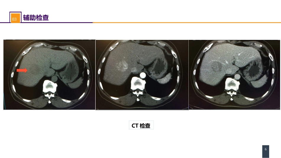结、直肠与肛管疾病 案例分析-结肠癌肝转移_第6页